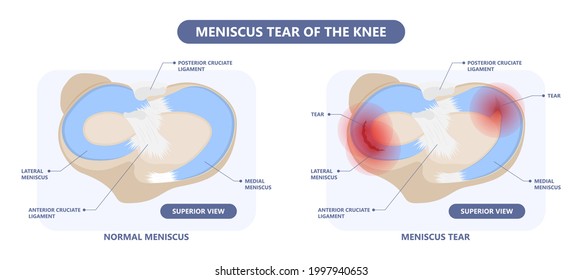 patella pain cap knee tear Torn injury Swelling bone leg exercise muscle jumper's runner's bursitis tendon tibia Anterior Cruciate Ligament ACL sport femur painful it band rupture Trauma joint cyst