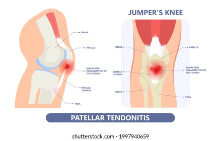 Osteoartritis de la Artritis Degenerativa Knee que causa dolor crónico