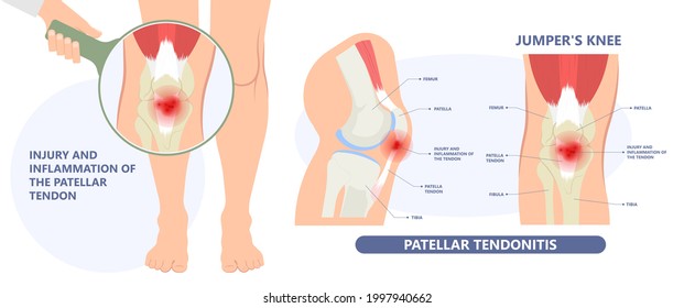 Patellar Tendonitis Entzündung der Patella tendon