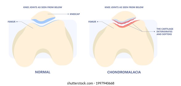 Patella Pain Cap Knee Tear Torn Injury Swelling Bone Leg Exercise Muscle Jumper's Runner's Bursitis Tendon Tibia Anterior Cruciate Ligament ACL Sport Femur Painful It Band Rupture Trauma Joint Cyst