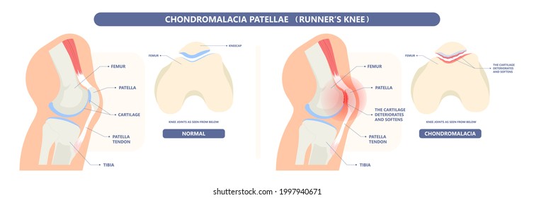 patella pain cap knee tear Torn injury Swelling bone leg exercise muscle jumper's runner's bursitis tendon tibia Anterior Cruciate Ligament ACL sport femur painful it band rupture Trauma joint cyst