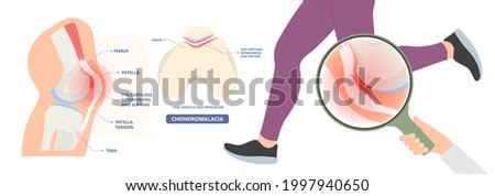 patella pain cap knee tear Torn injury Swelling bone leg exercise muscle jumper's runner's bursitis tendon tibia Anterior Cruciate Ligament ACL sport femur painful it band rupture Trauma joint cyst Stock foto © 