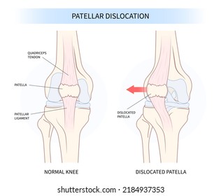 patellar dislocated and subluxation patella dysplasia Painful Joint