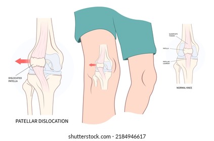 patellar dislocated and subluxation patella dysplasia Painful Joint