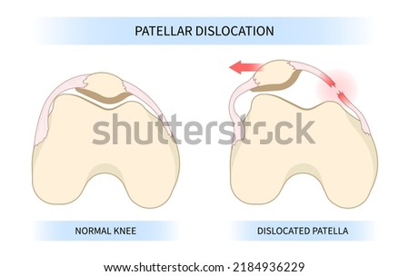 patellar dislocated and subluxation patella dysplasia Painful Joint ストックフォト © 