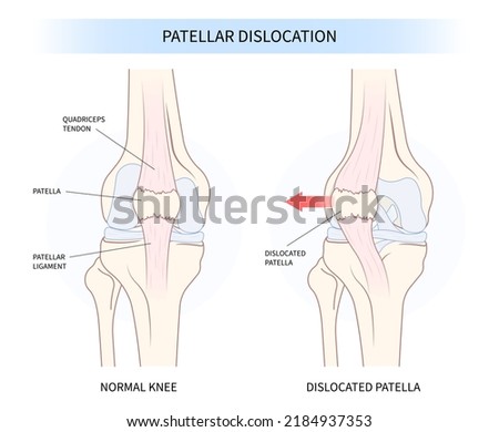 patellar dislocated and subluxation patella dysplasia Painful Joint Stock foto © 