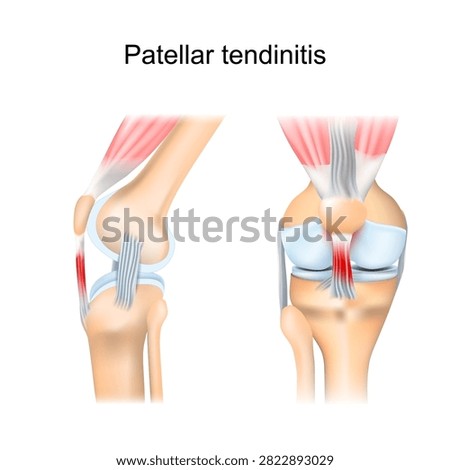 Patellar tendinitis. Patellar tendon inflammation. Structure of leg joint. Knee anatomy and overuse injury mechanism. Medical infographic diagram.
