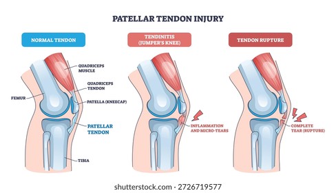 Patellar tendon injury visualizes normal, tendinitis, and rupture, focusing on patella, patellar tendon, and quadriceps to convey knee pain progression. Outline diagram