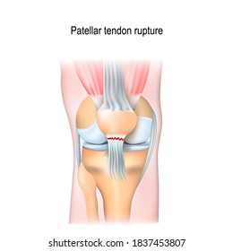 Patellartendon bricht. Kniegelenk mit Patella und Tendon Tränen.