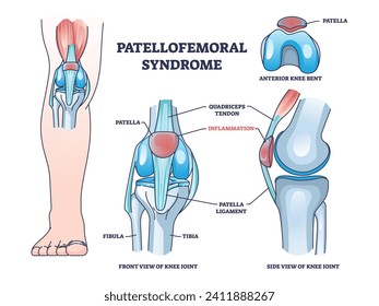 Patellofemoral pain syndrome as anatomical knee condition outline diagram. Labeled educational scheme with leg kneecap patella part inflammation vector illustration. Joint quadriceps tendon location