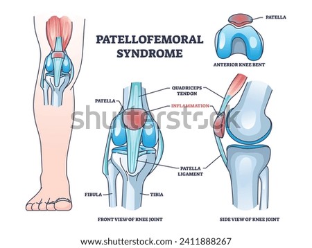 Patellofemoral pain syndrome as anatomical knee condition outline diagram. Labeled educational scheme with leg kneecap patella part inflammation vector illustration. Joint quadriceps tendon location ストックフォト © 
