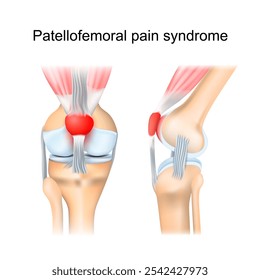 Patellofemoral pain syndrome. Frontal and side view of human knee joint. Synovial joint anatomy. Runner’s knee pain. Vector poster