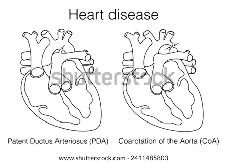 Patent Ductus Arteriosus and Coarctation of the aorta. Types of heart defects. Congenital defects of the heart muscle. Images produced without the use of any form of AI software at any stage.  Stock photo © 