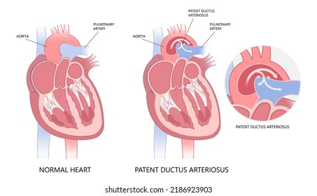 patent ductus arteriosus of pulmonary arteries