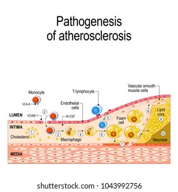 Pathogenesis of atherosclerosis. Cholesterol plaque, and thrombus formation. Cardiovascular disease. Vector illustration for medical, educational, and  science use