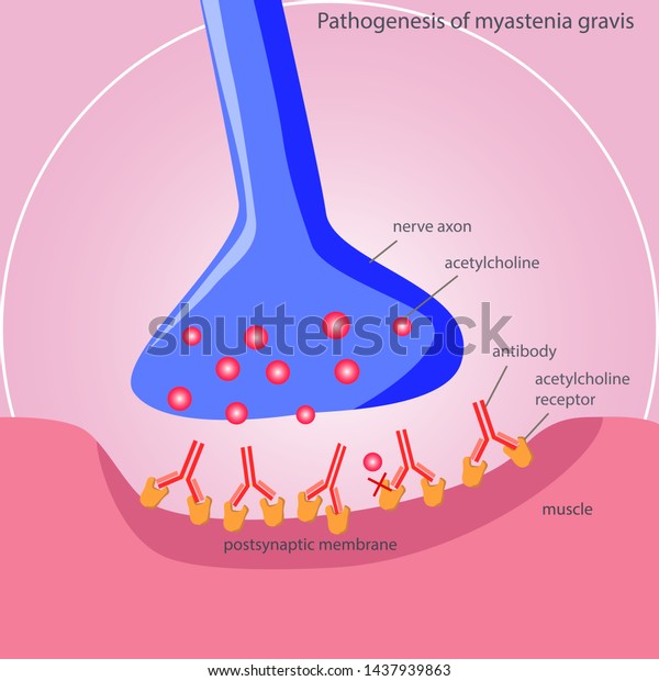 Pathogenesis Myasthenia Gravis Stock Vector (Royalty Free) 1437939863 ...