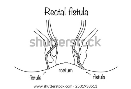 A pathological canal that forms in the soft tissues of the perianal area. Hand-drawn rectal fistula. Medical illustration for different uses.