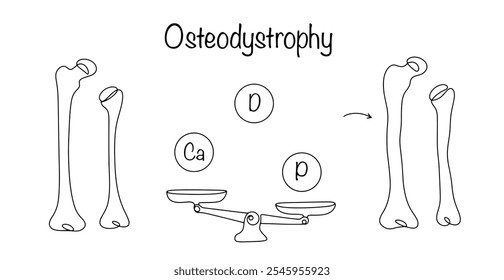 Pathologischer Zustand, gekennzeichnet durch eine Störung der Struktur und Funktion des Knochengewebes aufgrund von Störungen des Mineralstoffwechsels, einschließlich Calcium, Phosphor und Vitamin D. Einfacher Vektor.