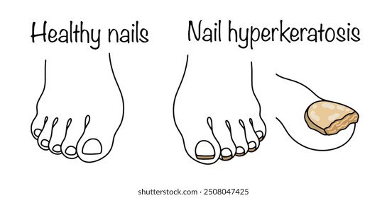 Ein pathologischer Zustand chronischer Natur, bei dem sich das Stratum corneum der Nägel verdickt. Ein gesundes Bein und ein Bein mit Anzeichen von Nagelhyperkeratose. Einfache Farbvektorgrafik.