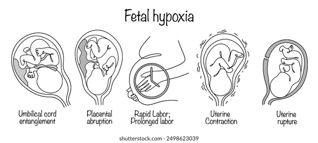 A pathological condition of the fetus that occurs as a result of oxygen deficiency. Hand-drawn main causes of fetal hypoxia. Medical vector for different uses.