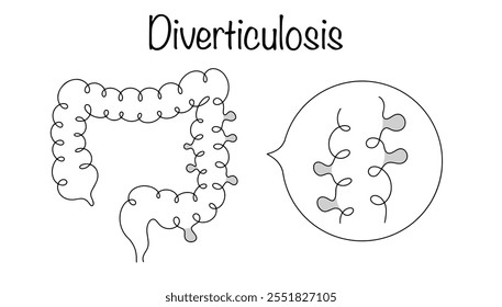 Una condición patológica de las paredes intestinales, acompañada de la aparición de hernias saculares en ellas. Dibujado a mano diverticulosis intestinal. Ilustración vectorial.