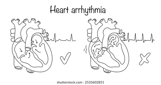 Uma condição patológica em que a frequência, a força e a sequência das contrações cardíacas são interrompidas. Coração saudável puxado à mão com cardiograma e manifestação de arritmia. Vetor.