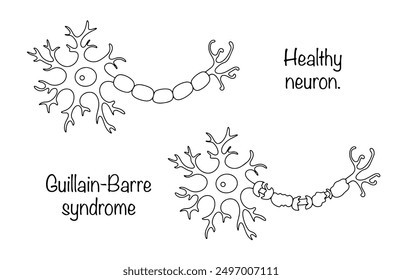 A pathological condition in which the immune system attacks certain parts of the nervous system. A hand-drawn illustration of a healthy neuron and a diseased neuron. Medical vector illustration.