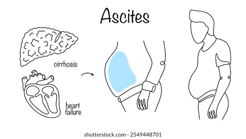 Uma patologia em que há um acúmulo de líquido livre na cavidade abdominal devido a cirrose do fígado ou insuficiência cardíaca. Um homem com manifestações de ascite. Vetor.