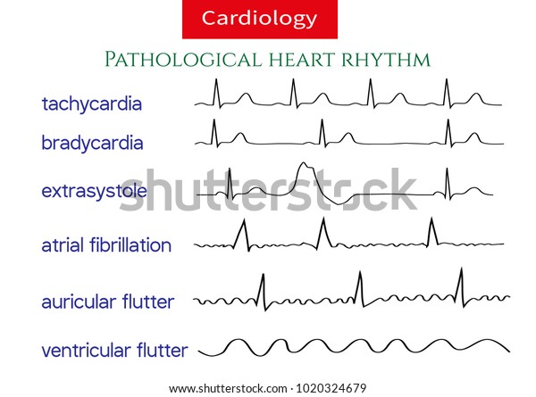 病理的心電図収集 さまざまな種類の不規則な心律のシェマティックベクターイラスト のベクター画像素材 ロイヤリティフリー