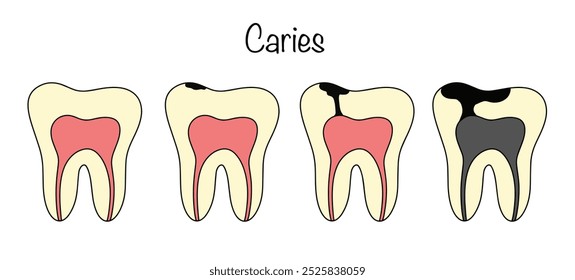 The pathological process of persistent destruction of tooth enamel and dentin with the formation of a defect in the form of a cavity. Hand-drawn stages of dental caries development. Vector.