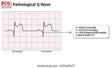 Criterio de ondas Q patológicas - Educación ECG con guía de estudio - Ilustración médica de vectores electrocardiográficos