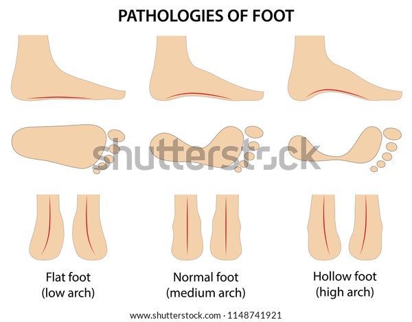 Pathologies Foot Difference Between Sick Healthy Stock Vector Royalty Free 1148741921