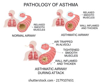 2,312 Asthma alveoli Images, Stock Photos & Vectors | Shutterstock