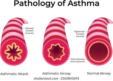 Pathology of Asthma, Asthma Normal Airway Asthmatic Airway Asthmatic Attack Design Vector Illustration