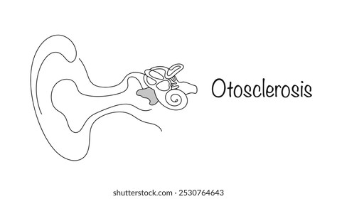 Patología del desarrollo del órgano auditivo, causada por el crecimiento de tejido óseo en el oído interno y medio. Una simple Ilustración vectorial sobre el tema de las enfermedades del oído. Vector médico.