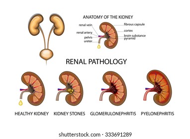 Glomerulonephritis Images, Stock Photos & Vectors | Shutterstock