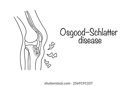 Pathology of the musculoskeletal system, characterized by destruction of the tibial core. Drawn knee joint with manifestation of disease. Hand drawn vector illustration on white background.