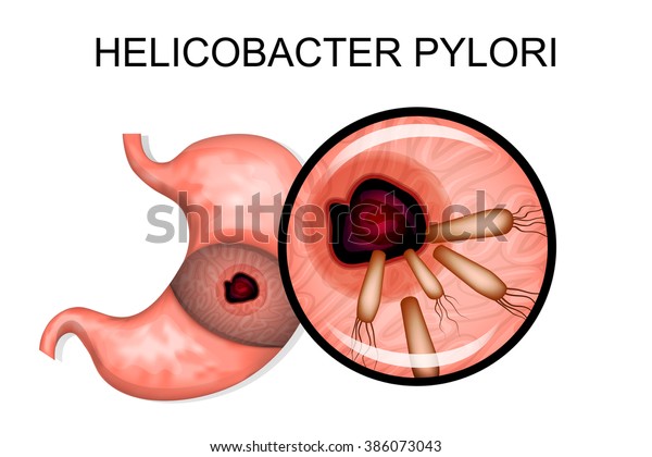 H Pylori Bacteria Infection Causes Symptoms And Treatment