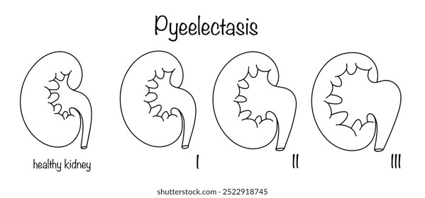 Patología del sistema urinario, en el que la pelvis renal se dilata como resultado de la acumulación de orina en ellos. Un riñón sano y un riñón en diferentes etapas de la enfermedad. Vector.