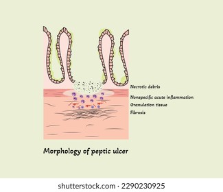 Pathophysiologie der Peptischen Ulzerkrankung Vektorgrafik