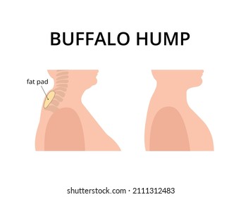 Patient with buffalo hump with fat deposits around the vertebrae. Dowager's hump, kyphosis, spine. For topics like post-menopause, osteoperosis, scoliosis