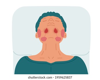 A patient with diseased sublingual salivary glands. Vector illustration of sialolithiasis.