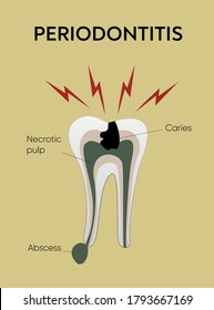 Afiche educativo para el paciente que muestra el proceso de formación de caries y periodontitis en el diente y las causas de las razones