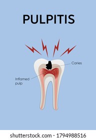 Afiche educativo del paciente que muestra el proceso de formación de caries y pulpitis en el diente y las causas de las causas