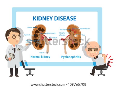 Patients and doctors Viewing diagrams Pyelonephritis. Vector illustration.