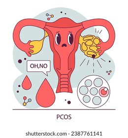 Síndrome de ovario poliquístico: Sistema reproductivo femenino. Enfermedad orgánica del sistema endocrino. Desequilibrio en la secreción de hormonas humanas. Ilustración vectorial plana