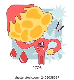 PCOS, polycystic ovary syndrome. Female reproductive system. Endocrine system organ disease. Human hormones secretion imbalance. Flat vector illustration