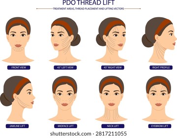 PDO Thread Lift Face Mapping Diagram Showing Thread Insertion Patterns and Lifting Vectors for Aesthetic Medicine. Thread Placement and Lifting Vectors for Facial Rejuvenation Medical Illustration