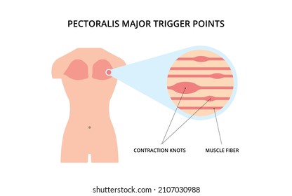 Pectoralis muscle trigger point. Myofascial release physical therapy, anatomy, medicine. For topics like sport, chronic pain, massage