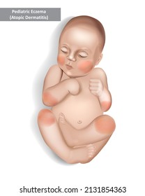 Pediatric Eczema Or Atopic Dermatitis In Infants And Children. Vector Illustration